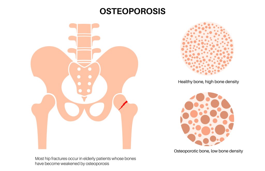 Bone Health and Osteoporosis Treatment in Rochester, NY: Expert Care for Stronger Bones
