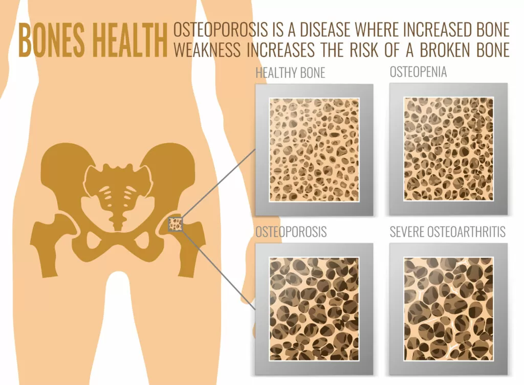 Bone Health and Osteoporosis Treatment in Rochester, NY: Expert Care for Stronger Bones