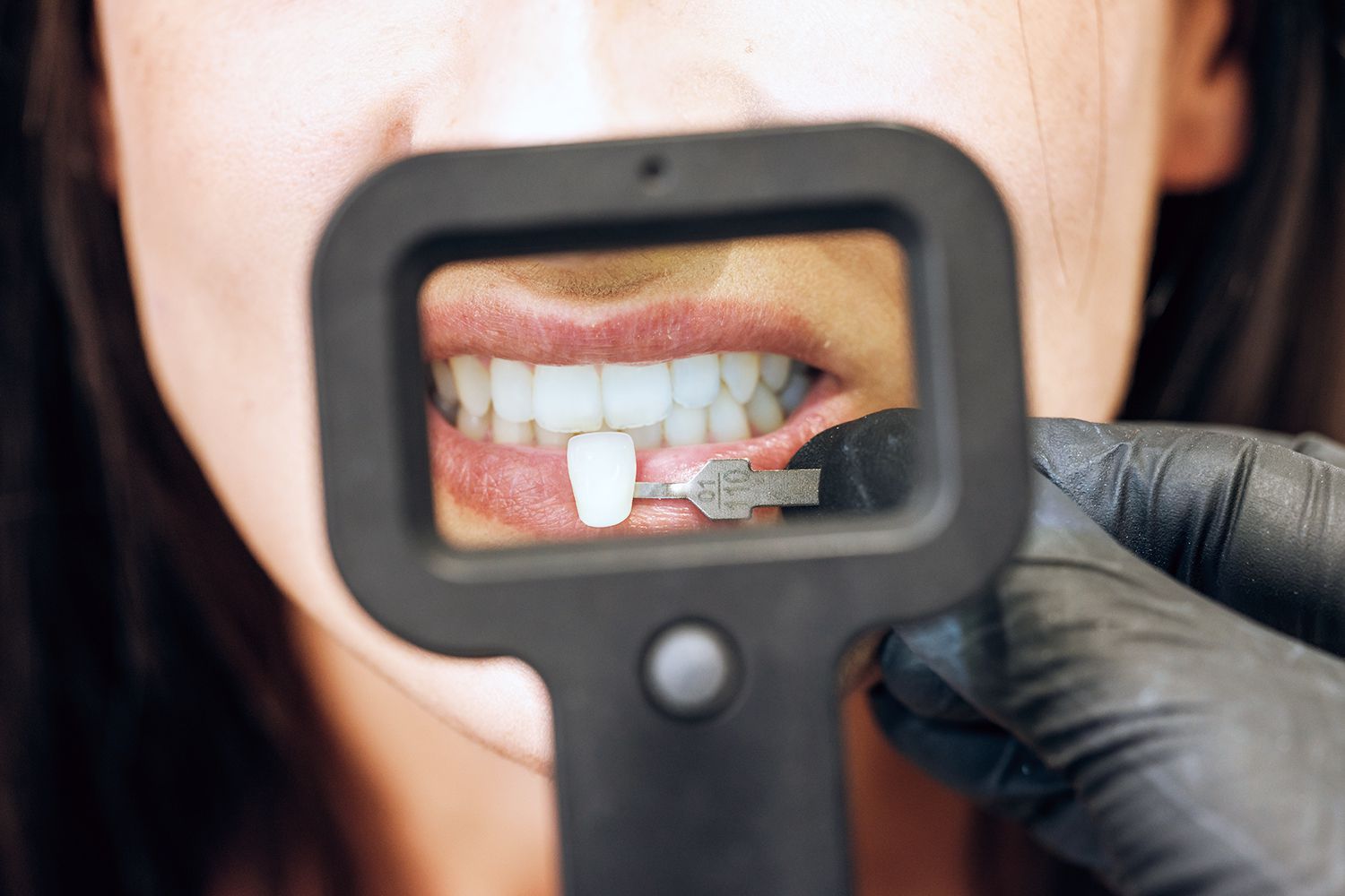 What is a Veneer Tech? A Quick Look into this Career Path
