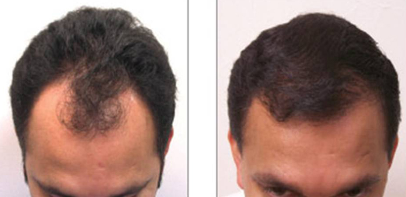 Hair Transplant Cost: Is It Worth the Money?