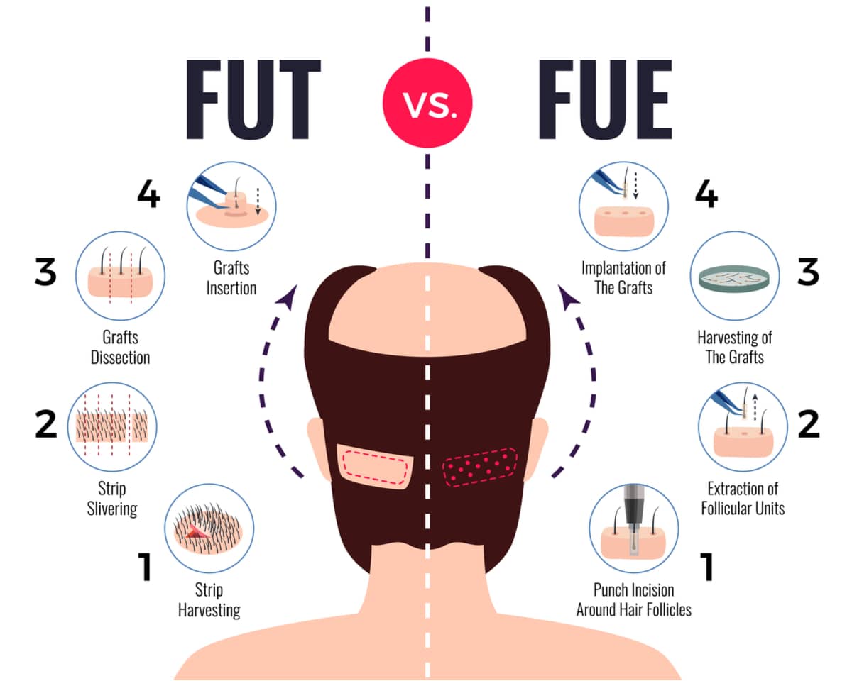 Hair Transplant Cost: Is It Worth the Money?