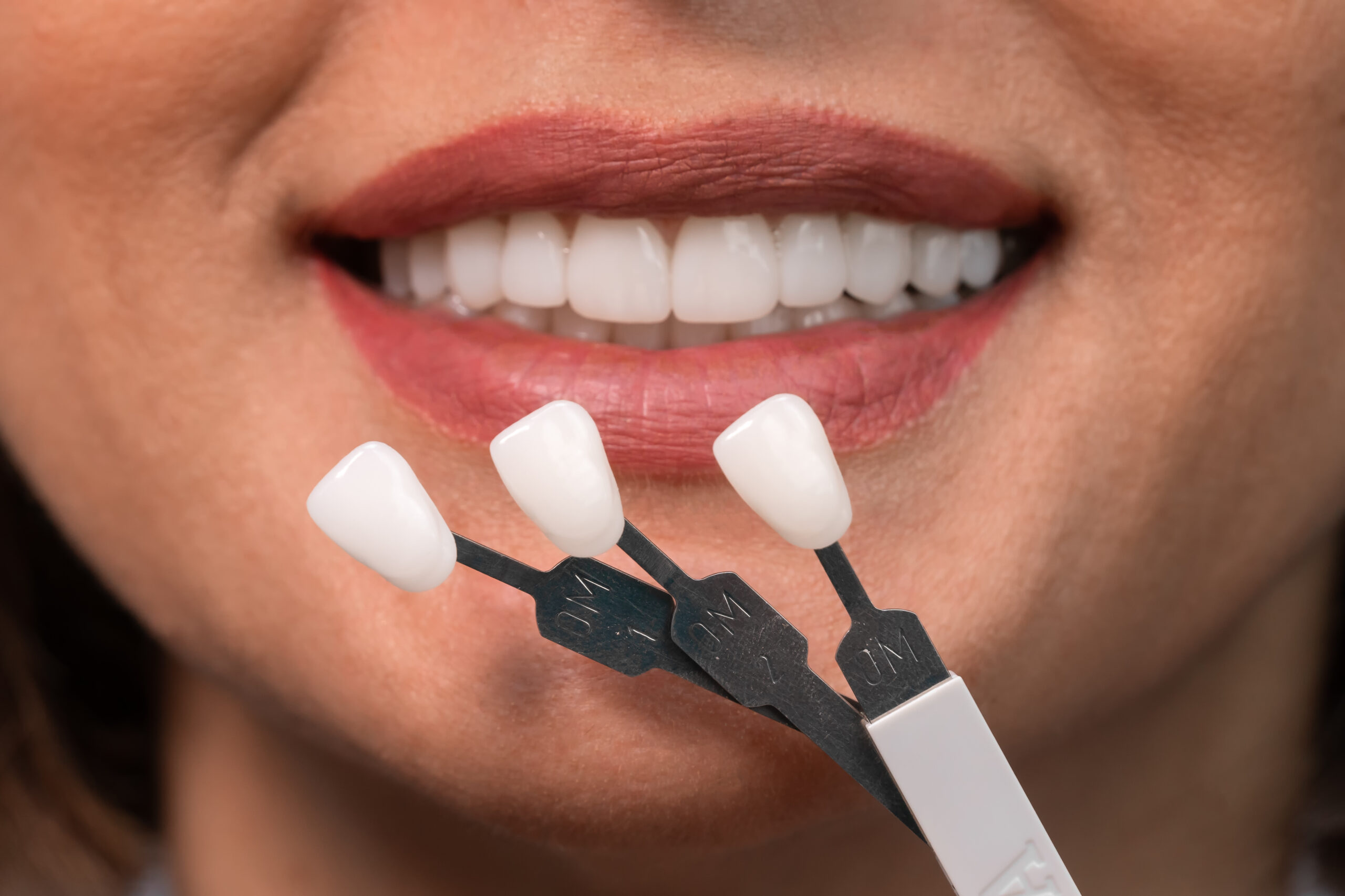 What is a Veneer Tech? A Quick Look into this Career Path