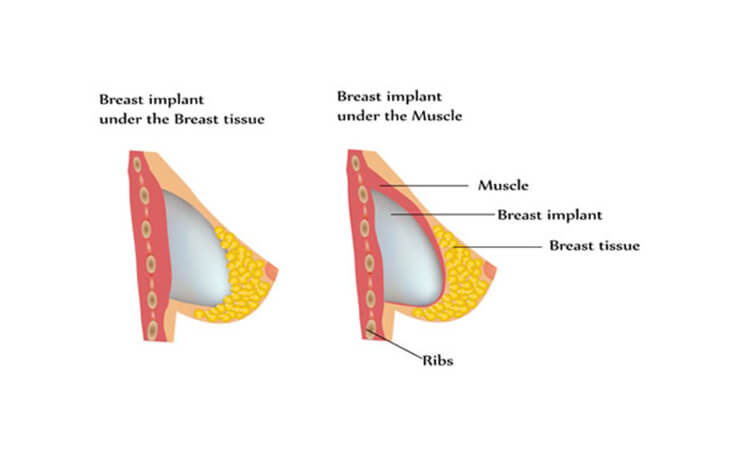 The Latest in Breast Implants: Check Out the Newest Breast Implant Technology