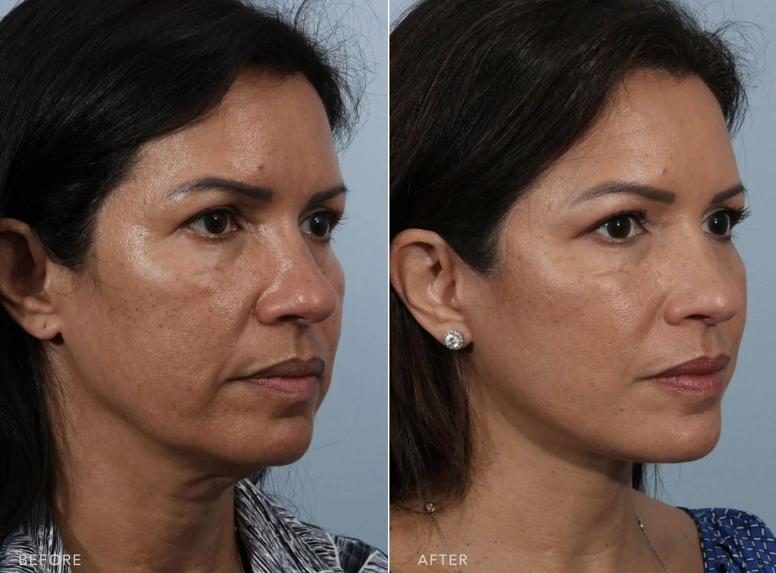 New Face Lift Technology: Cost and Recovery Explained