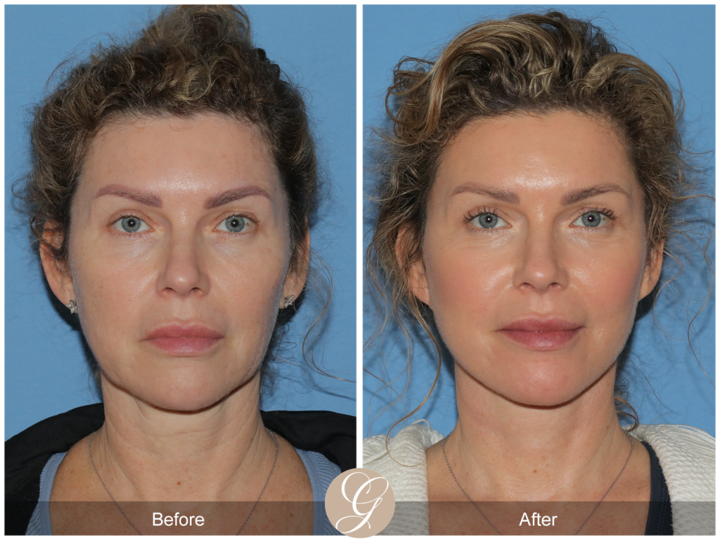 New Face Lift Technology: Cost and Recovery Explained